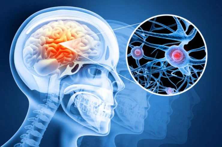 Brain Stroke Prevention & Recovery