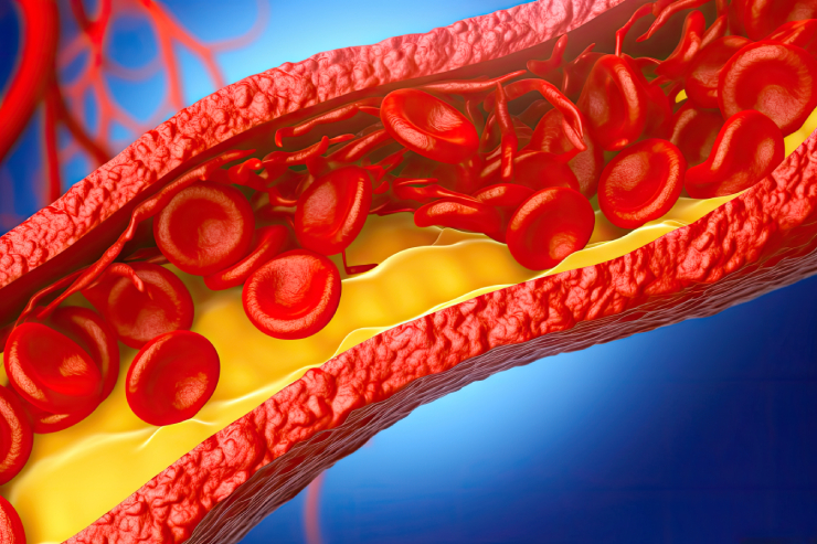 Dyslipidemia